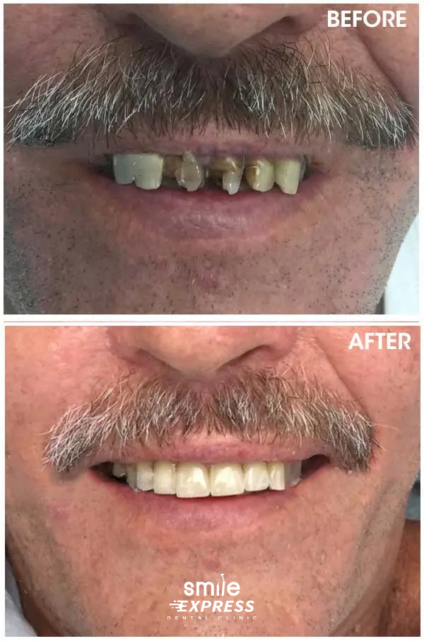 review Dental Crowns thailand case 3