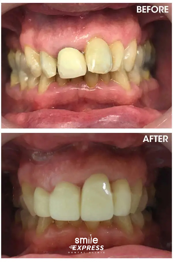 review Dental Crowns thailand
