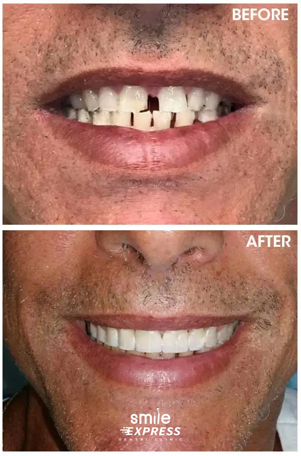 review Dental Crowns thailand case 2